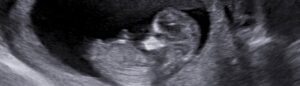 Gravid scanning på scanningklinik