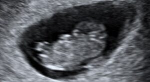 Gravid scanning klinik